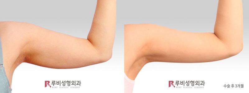 Arm liposuction