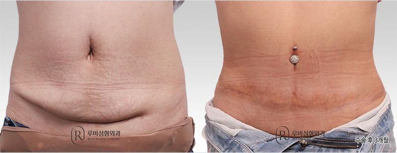 Abdominoplasty