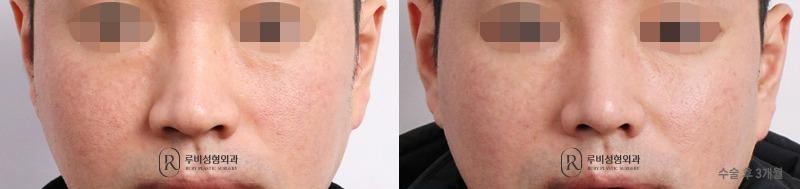 Men's nose surgery (nose bridge, nose tip, humpectomy, alar cinching)