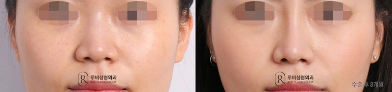 Nose surgery (nose bridge, nose tip, short nose correction)