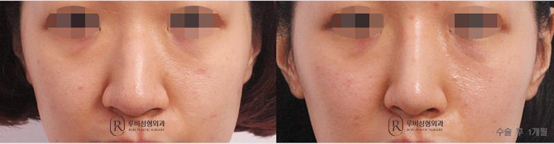 Nose Surgery