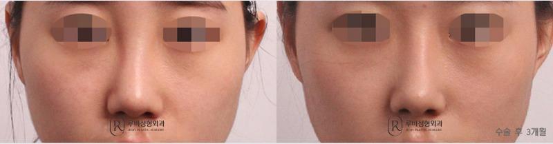 Nose Surgery