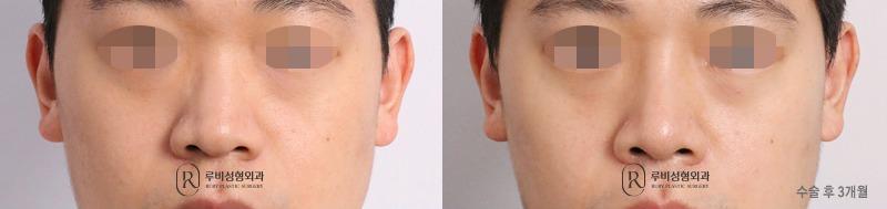 Men's nose surgery (nose bridge, nose tip, bulbous nose correction, humpectomy, alar cinching)