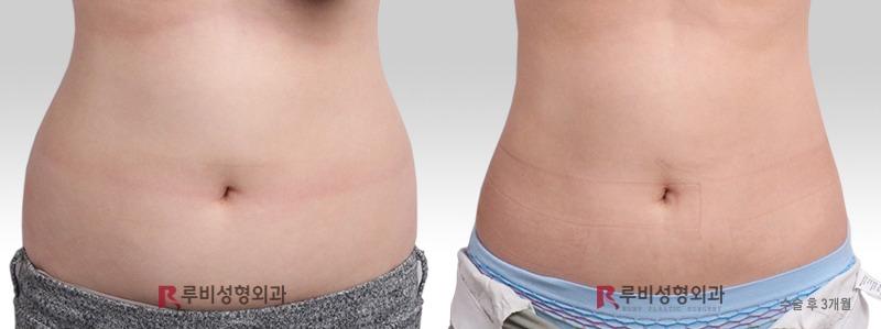 Abdominal liposuction