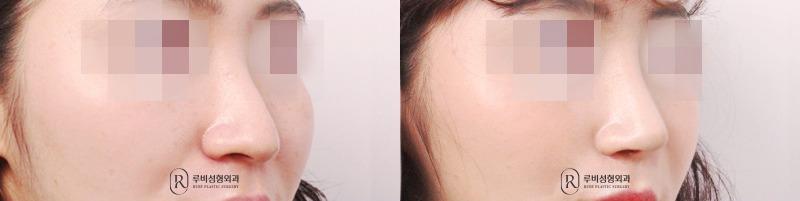 Nose Surgery