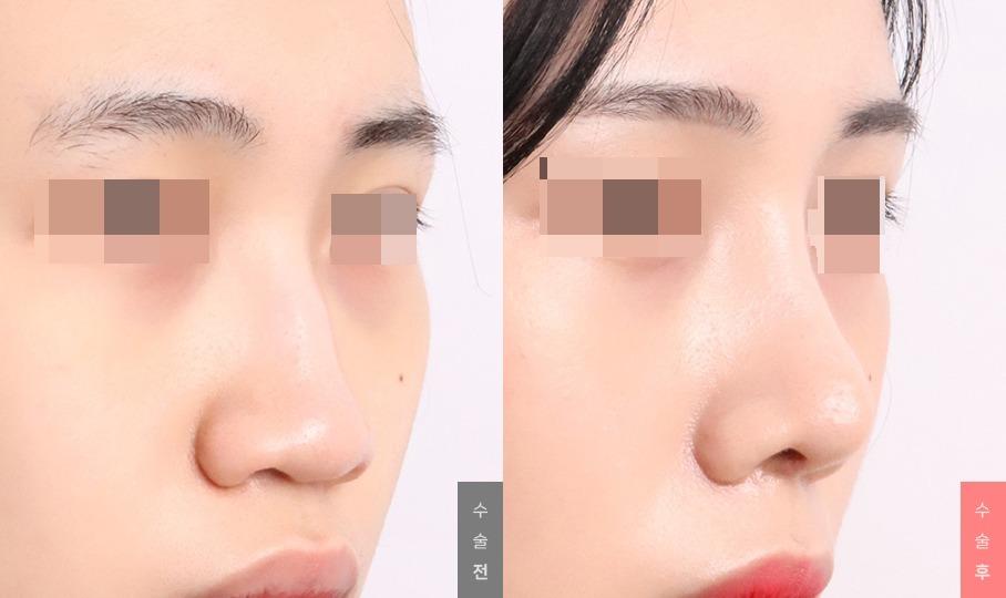 Nose Surgery, Nose Bridge + Nose Tip + Humpectomy + Long Nose Correction