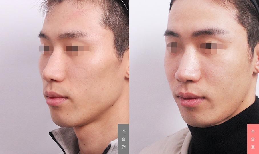 Contouring, Zygoma Reduction