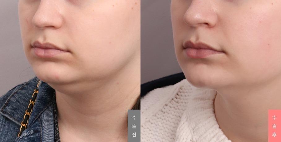 Youthful Face Surgery, Neck Lift