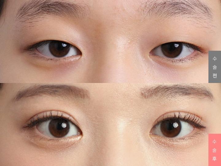 Eye Surgery, Natural Adhesion + Ptosis Correction