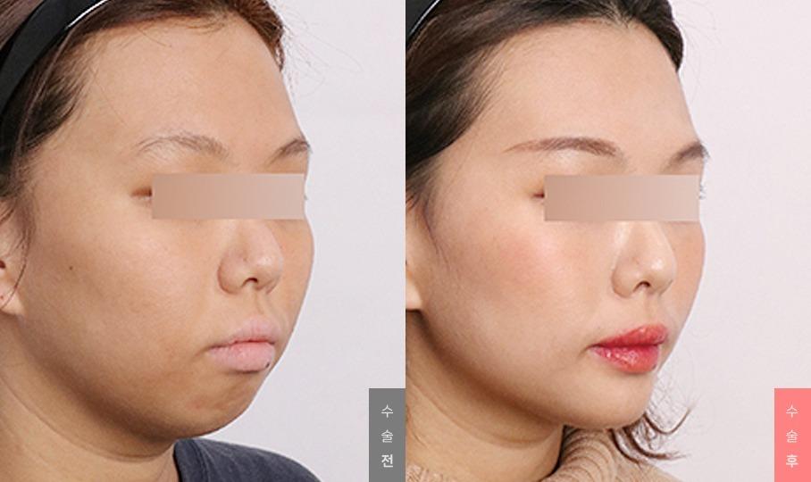 Face Contour Surgery, Chin Implant for Receding Chin