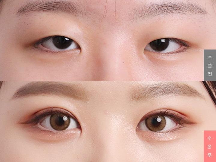 Eye Surgery, Natural Adhesion + Ptosis Correction