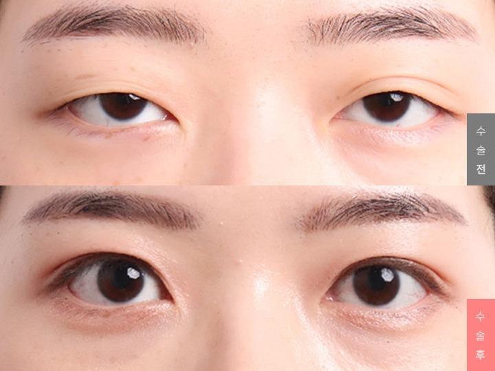 Eye Surgery, Natural Adhesion + Ptosis Correction