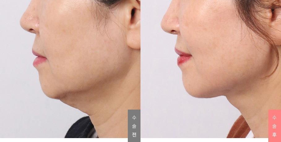 Youthful Face Surgery, Neck Lift