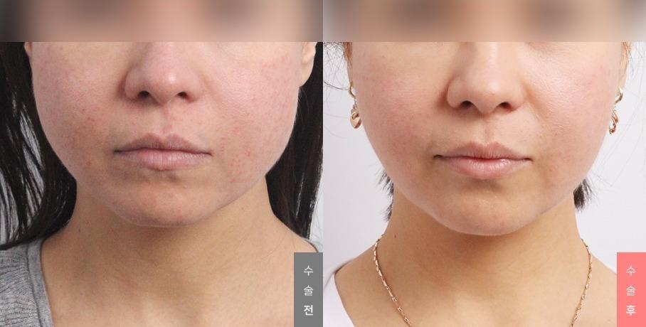 Youthful Face Surgery, Thread Lifting