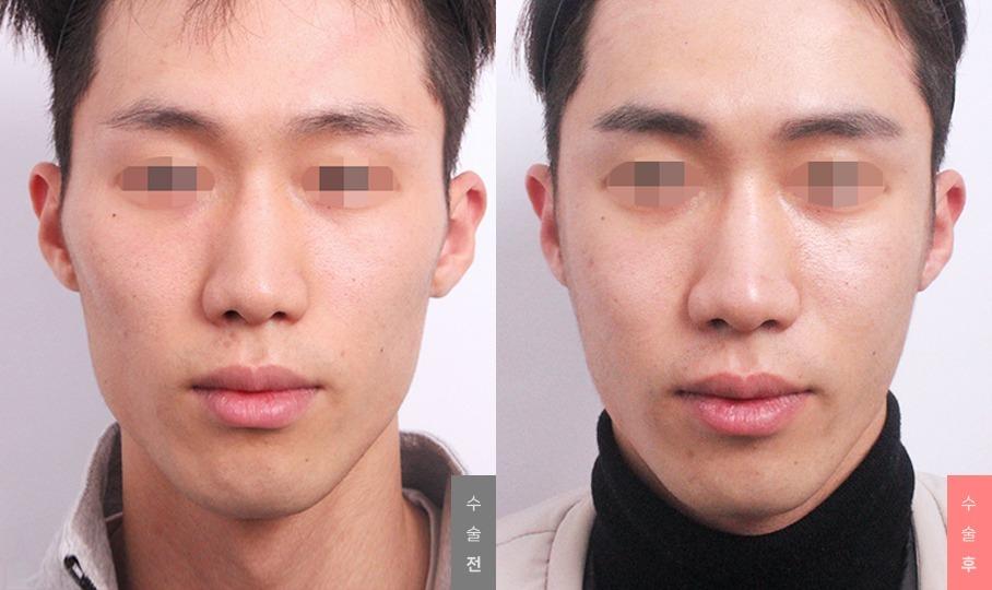 Contouring, Zygoma Reduction