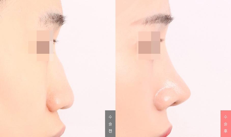 Nose Surgery, Nasal Bridge + Nasal Tip + Humpectomy + Long Nose Correction