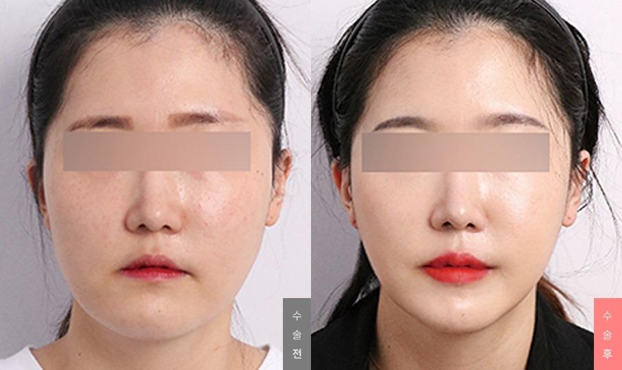 Face Contour Surgery, Angle Reduction + Zygoma Reduction + Cortical Osteotomy