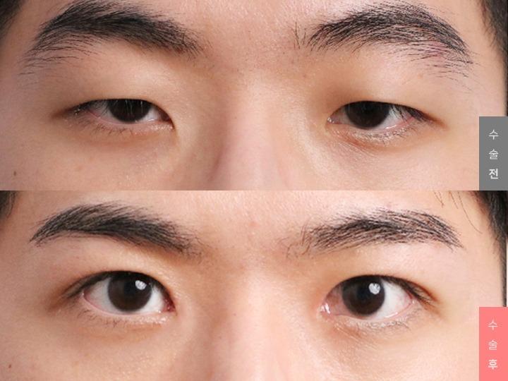 Eye Surgery, Natural Adhesion + Ptosis Correction + Epicanthoplasty