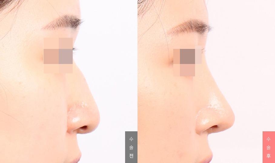Nose Surgery, Nasal Bridge + Nasal Tip + Humpectomy + Long Nose Correction