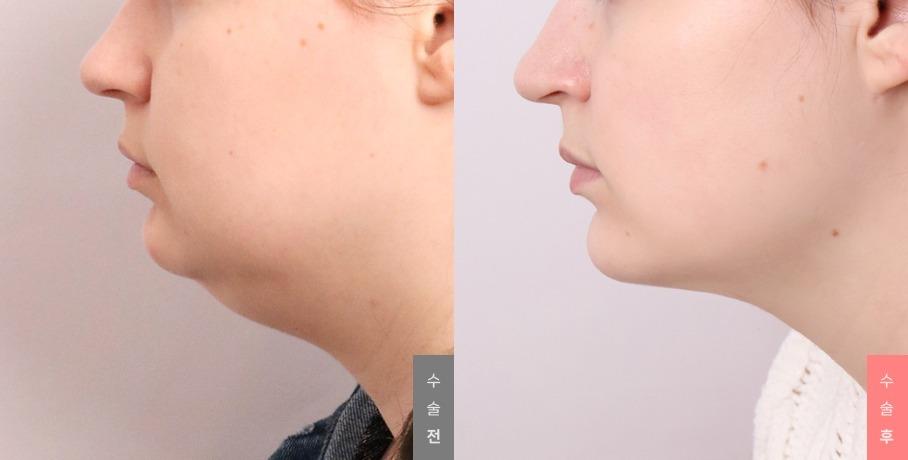 Youthful Face Surgery, Neck Lift