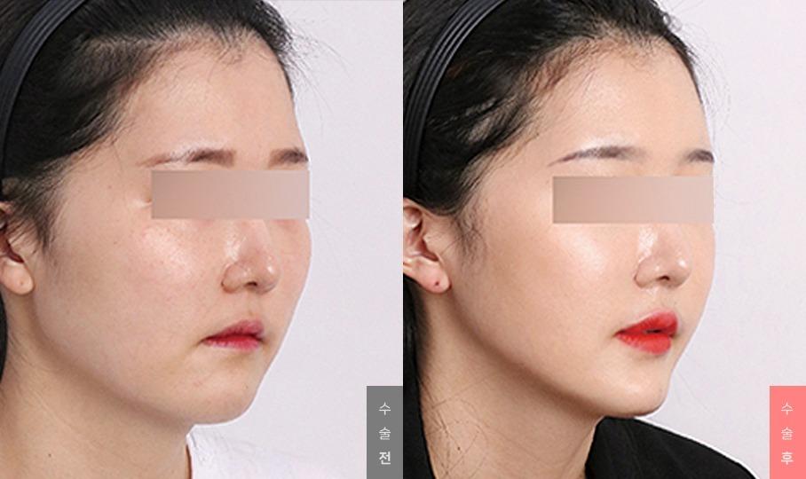 Face Contour Surgery, Angle Reduction + Zygoma Reduction + Cortical Osteotomy
