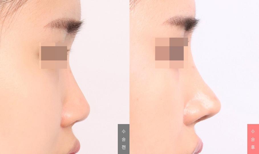 Nose Surgery, Nasal Bridge + Nasal Tip + Short Nose Correction