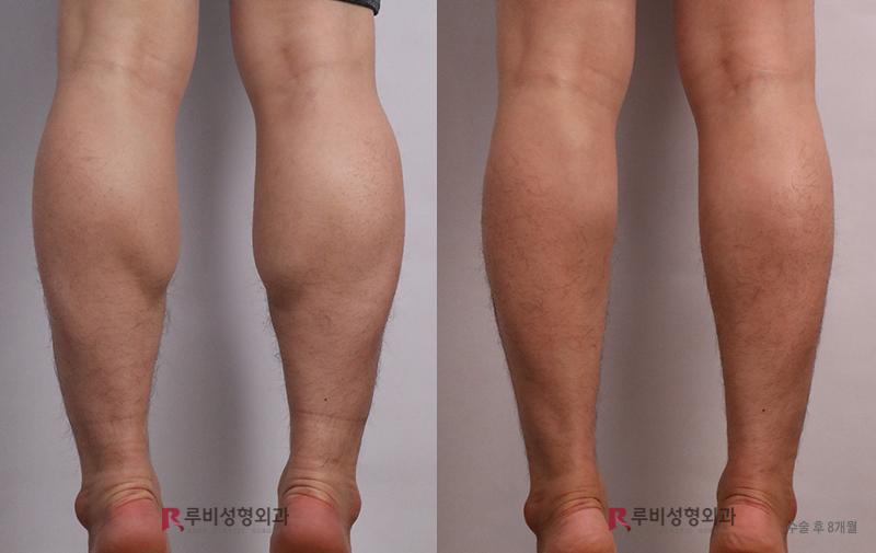 Men's calf contouring (nerve block)