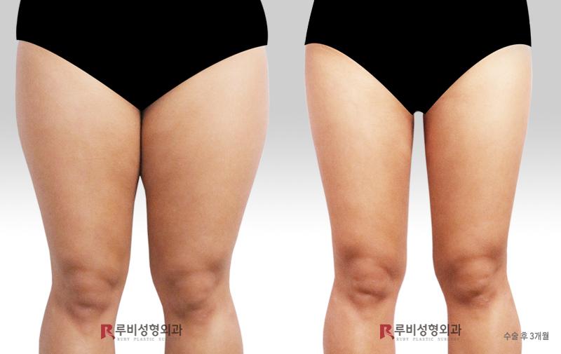 Thigh liposuction