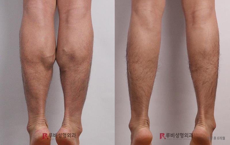 Men's calf contouring (nerve block)
