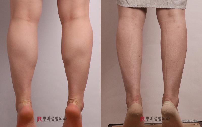 Calf contouring (selective nerve block)