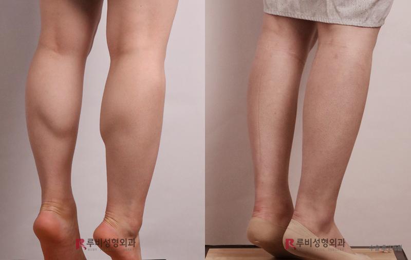 Calf contouring (selective nerve block)