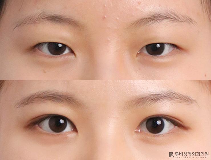 Natural adhesion, ptosis correction, epicanthoplasty