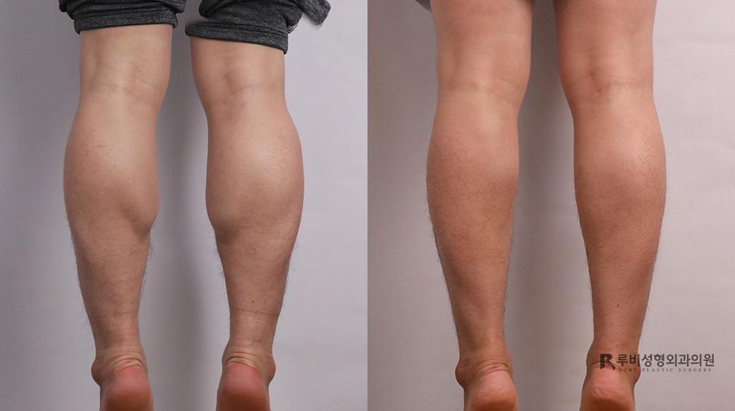 Calf Reduction