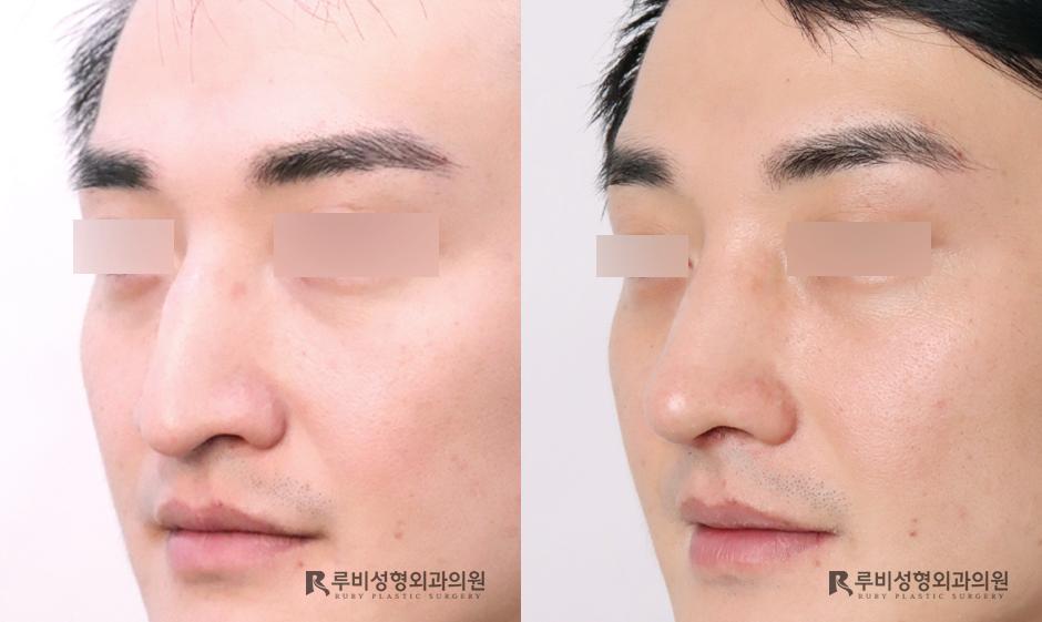 Nose bridge, nose tip, humpectomy, long nose correction