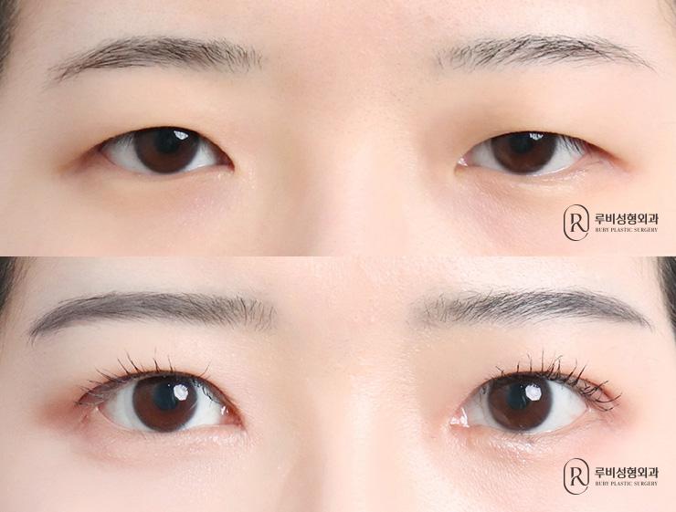 Natural adhesion, ptosis correction, epicanthoplasty
