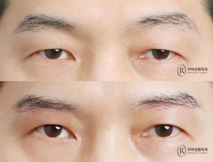 Men's brow lift