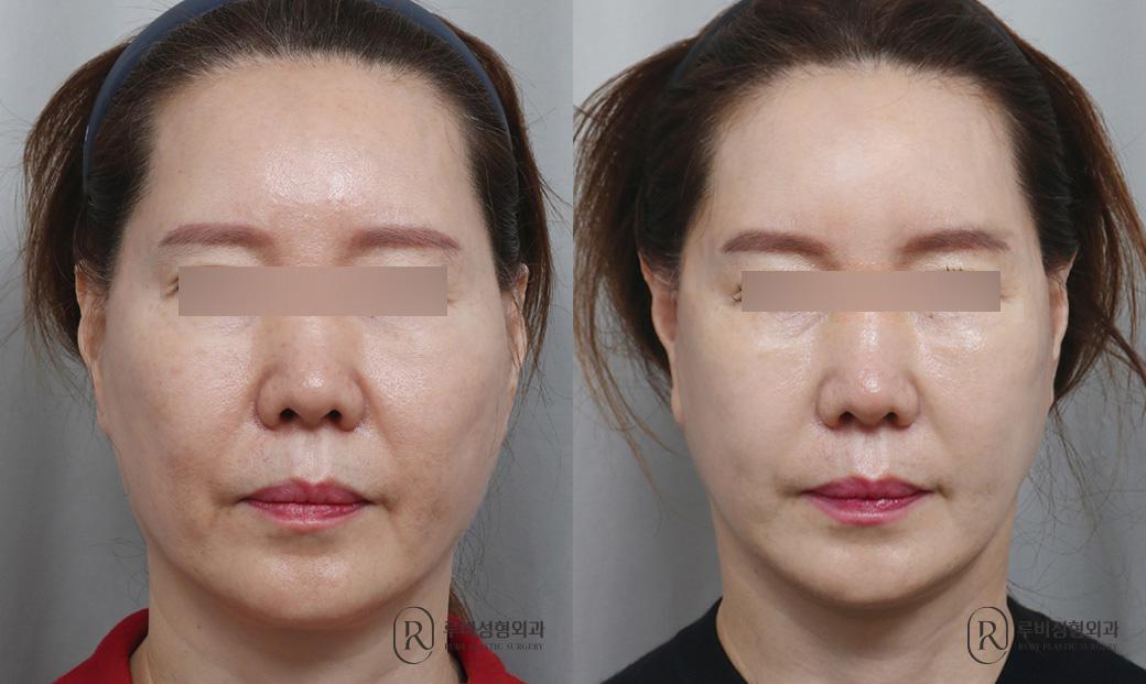 Face Lift