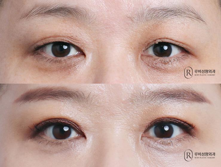 Natural adhesion, ptosis correction, revision surgery
