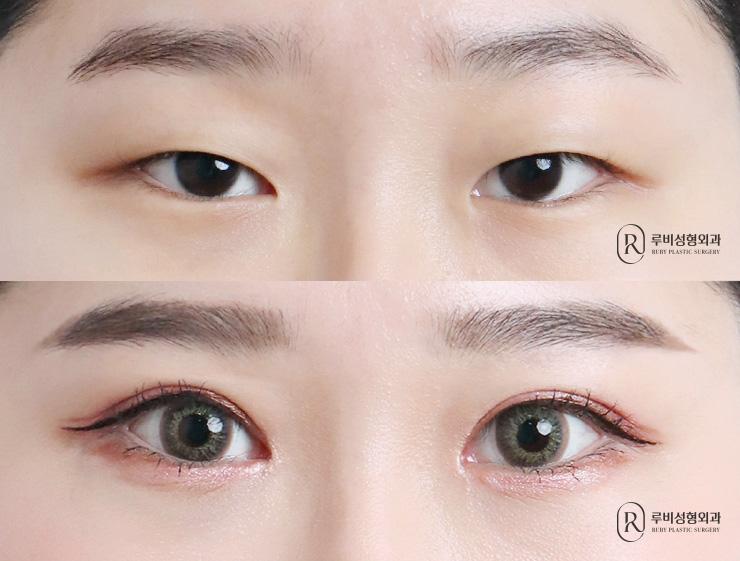 Natural adhesion, ptosis correction, epicanthoplasty