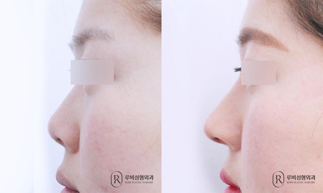 Nose bridge, nose tip, humpectomy, short nose correction
