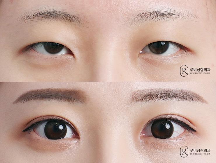 Natural adhesion, ptosis correction, epicanthoplasty