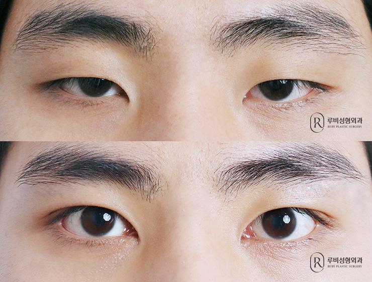 Men's natural adhesion, ptosis correction, epicanthoplasty
