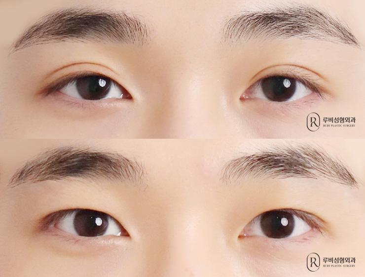 Men's natural adhesion, ptosis correction