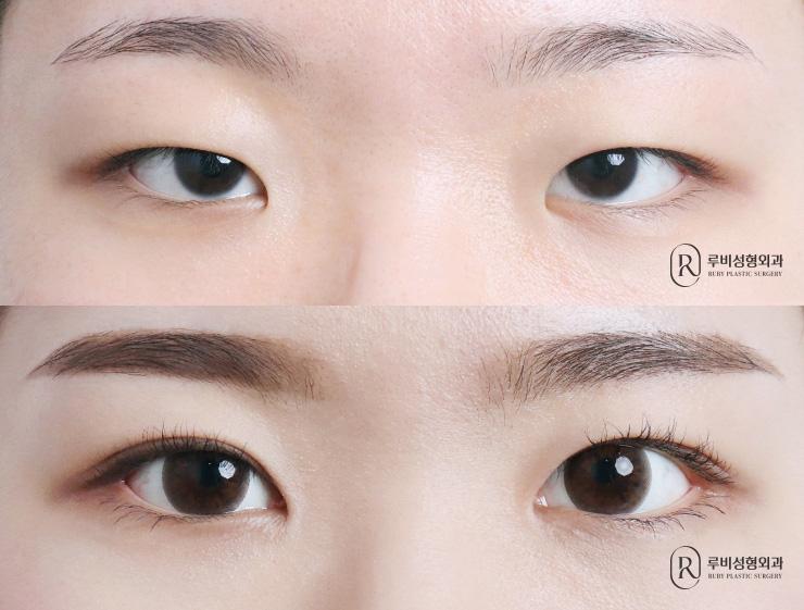 Natural adhesion, ptosis correction