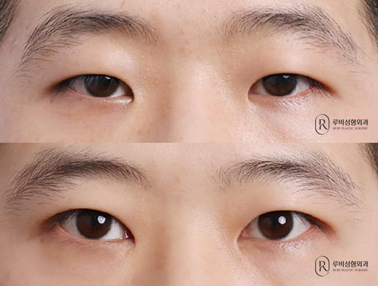 Men's natural adhesion, ptosis correction, epicanthoplasty