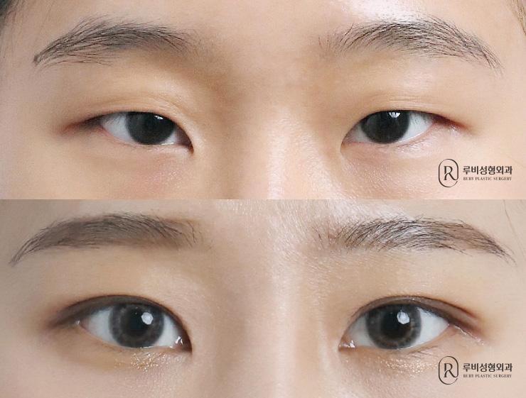 Natural adhesion, ptosis correction, epicanthoplasty