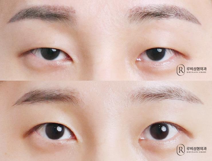 Men's natural adhesion, ptosis correction