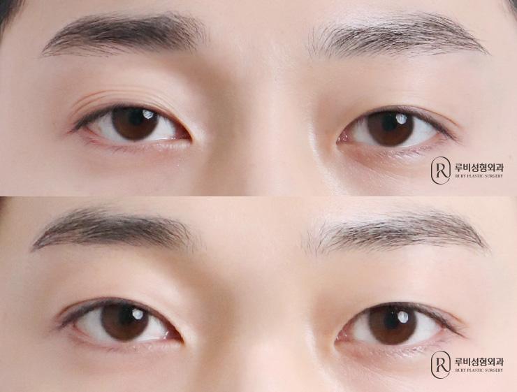 Men's natural adhesion, ptosis correction