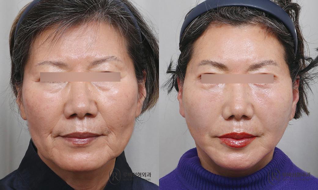 Face Lift