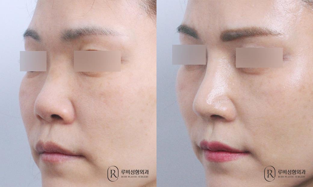 Nasal bridge, nasal tip, short nose correction